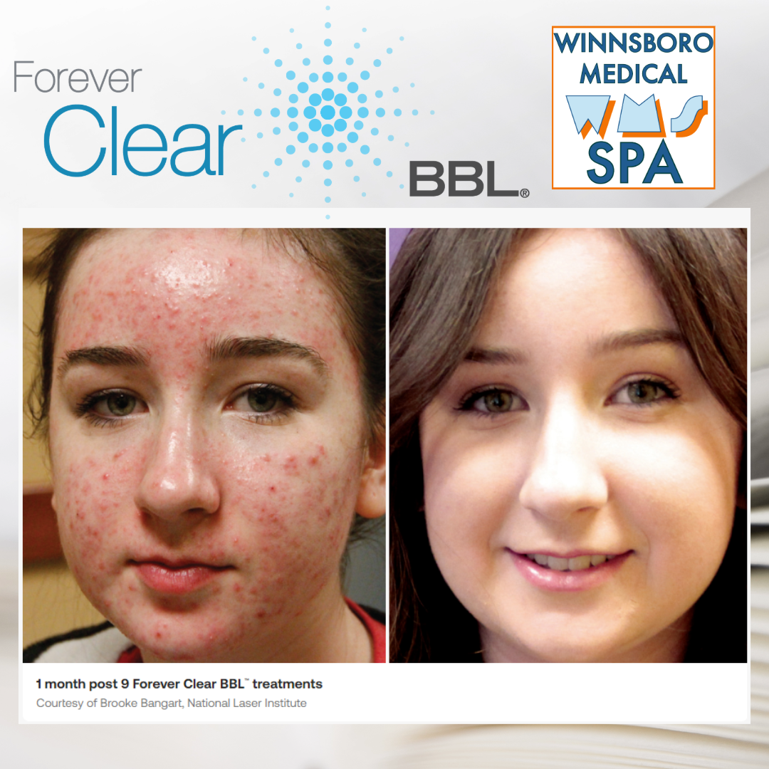 Sciton Forever Clear BBL Acne Treatment | Winnsboro Medical Spa