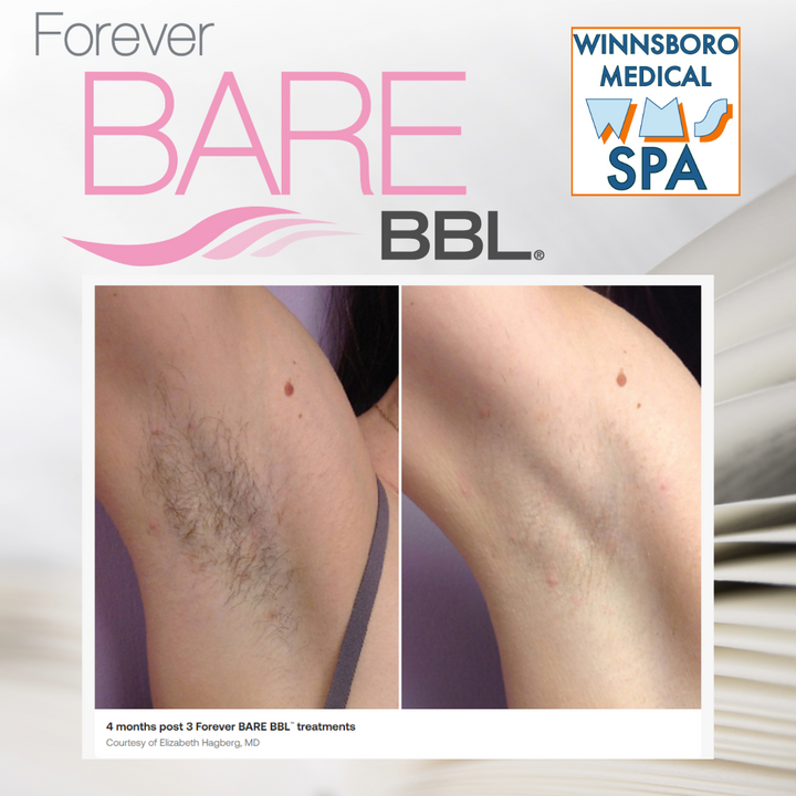 Sciton Forever Bare BBL Hair Reduction | Winnsboro Medical Spa