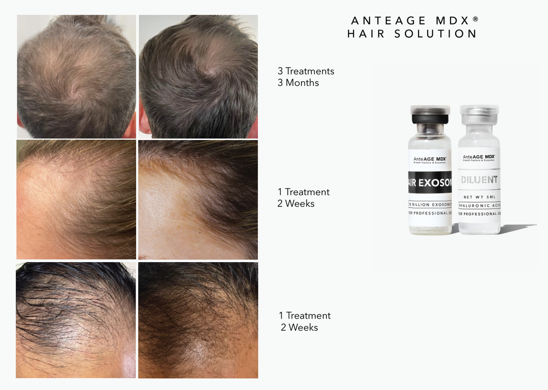 AnteAGE MDX Hair Exosomes | Winnsboro Medical Spa