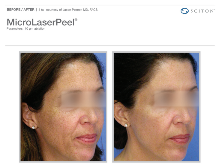 NanoLaserPeel – Laser Skin Resurfacing for Radiant, Smooth Skin