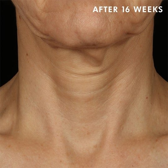 Tripeptide-R Neck Repair