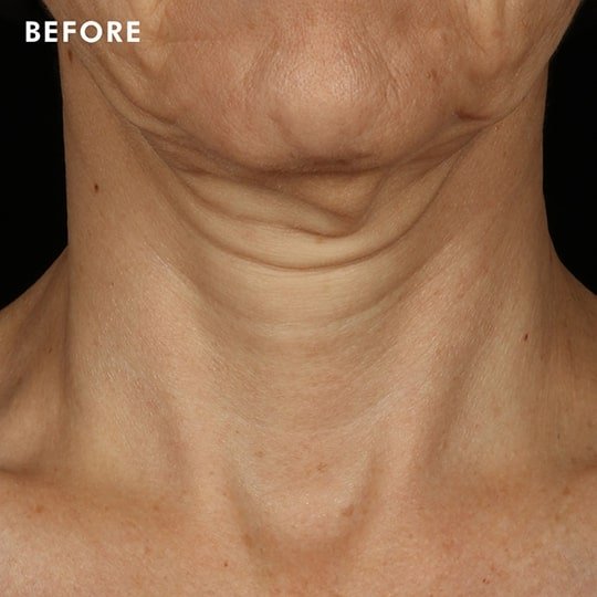 Tripeptide-R Neck Repair