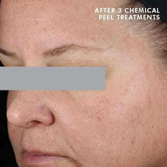 Chemical Peels